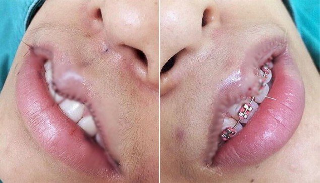 Новый тренд азиатских женщин: уменьшение губ