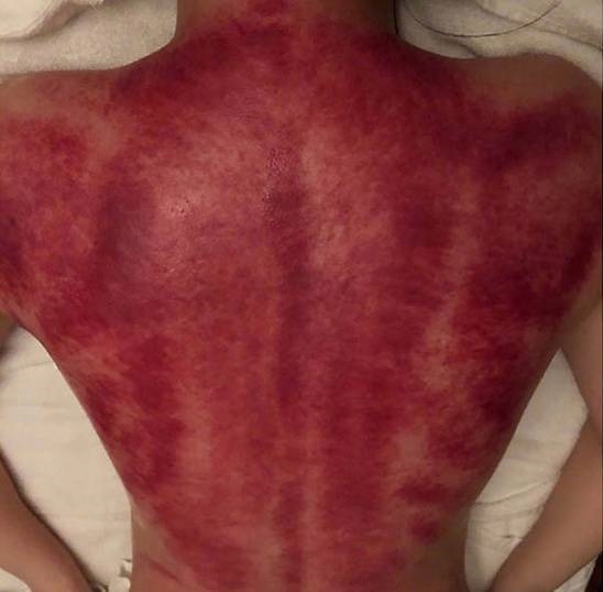 Джиллиан Чун загрузила шокирующую фотографию своей спины