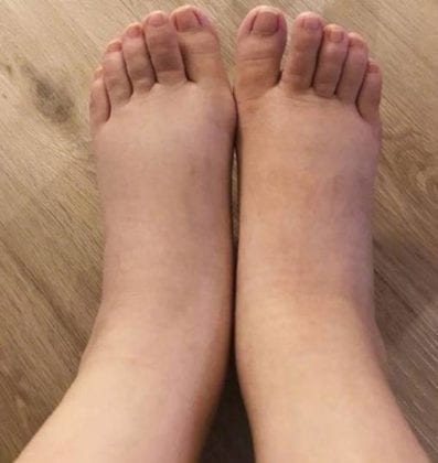 Линн Хун пожаловалась поклонникам на отёк ног после родов