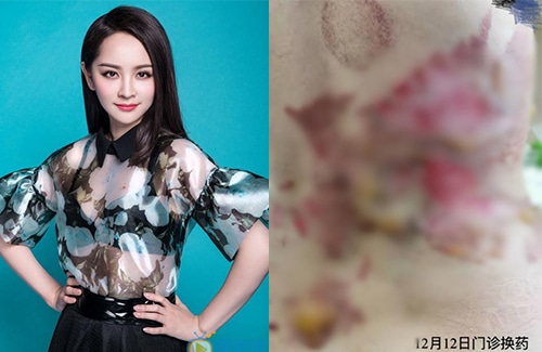 Актриса Дэн Ша получила серьёзные ожоги после сеанса купирования