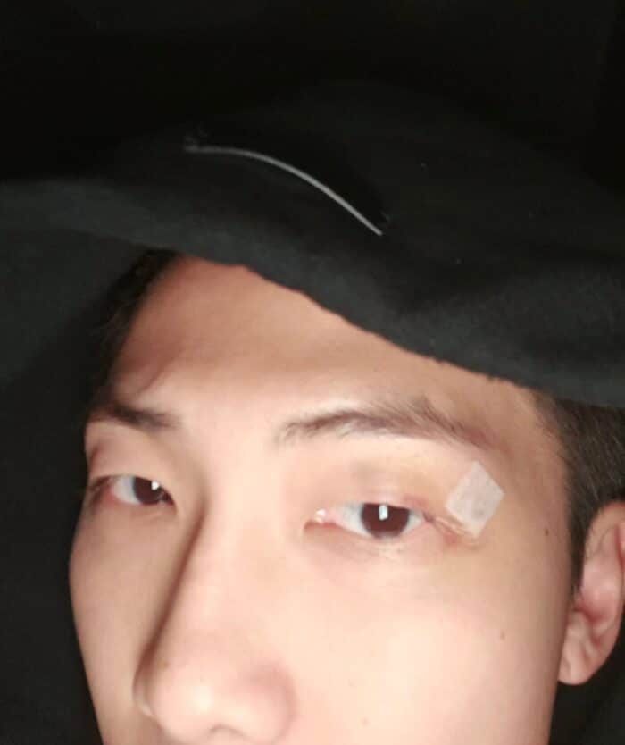 RM из BTS рассказал фанатам о процессе заживления раны около глаза